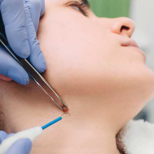 image of the RF Face tightening treatment